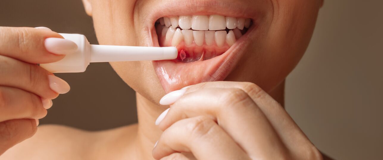 Parodontitis: Wat is het en hoe voorkom je het?