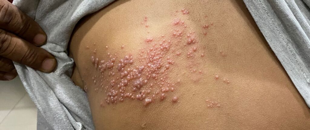 Huidige afbeelding: gordelroos