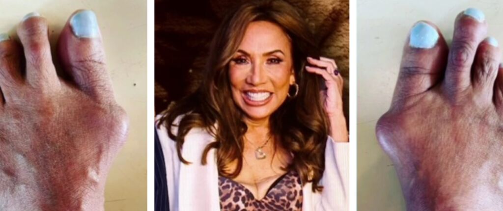 Huidige afbeelding: Patty Brard herstelt van voetoperatie.