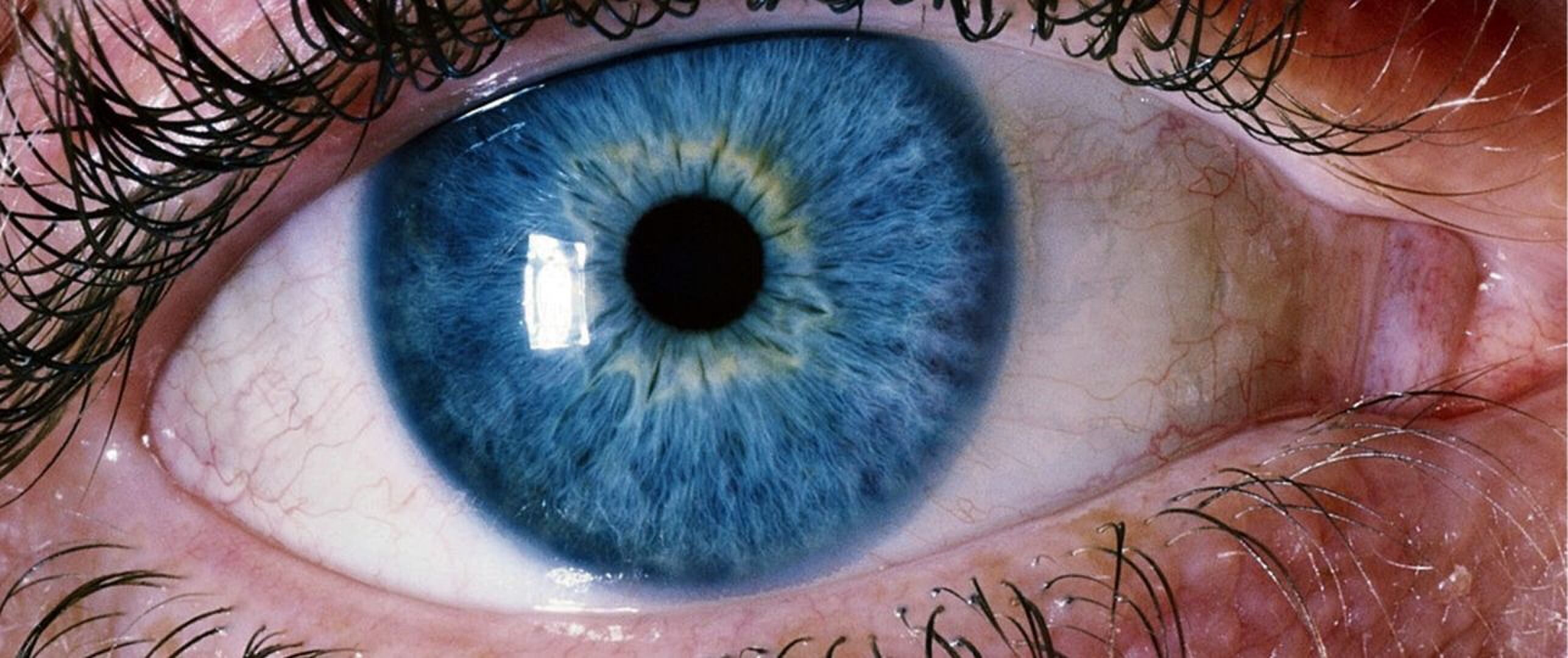 Ooginfarct (NAION) bij Ozempic of Wegovy?