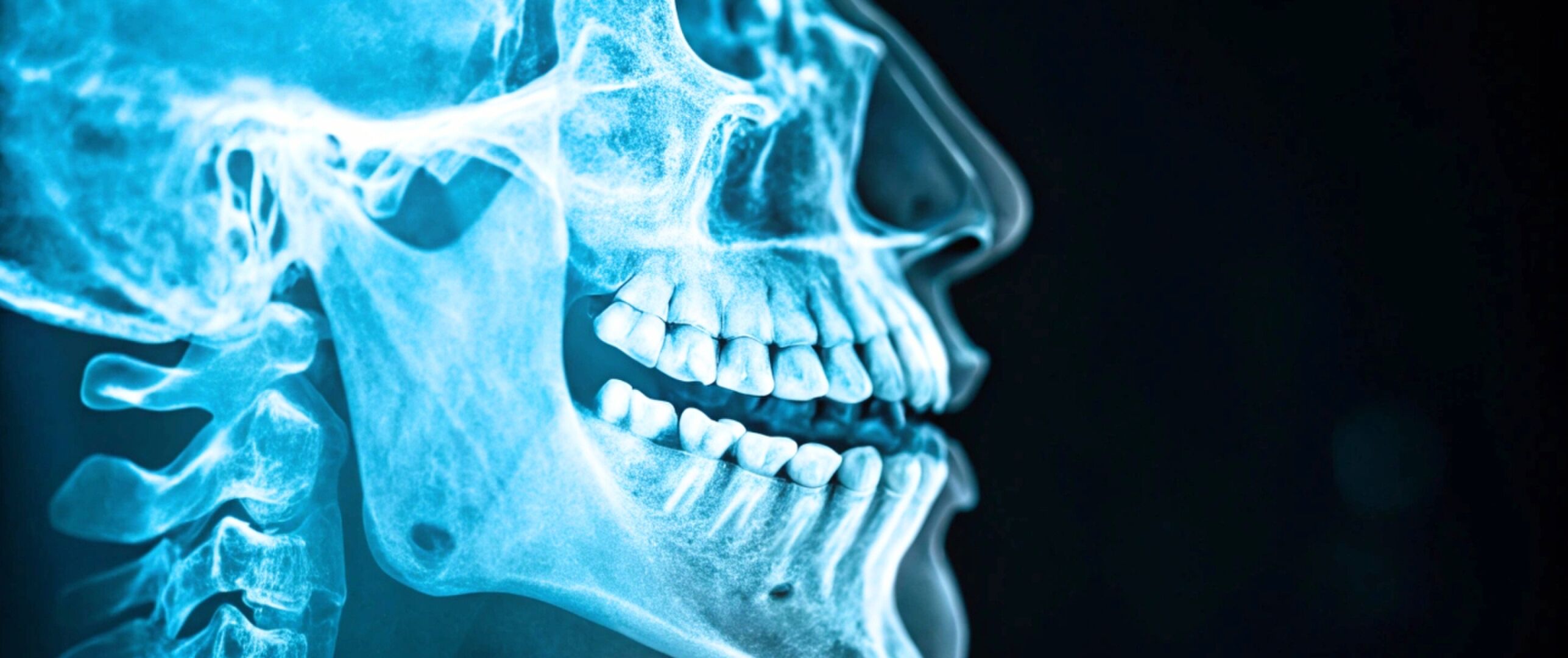 Ziekte van Van Buchem