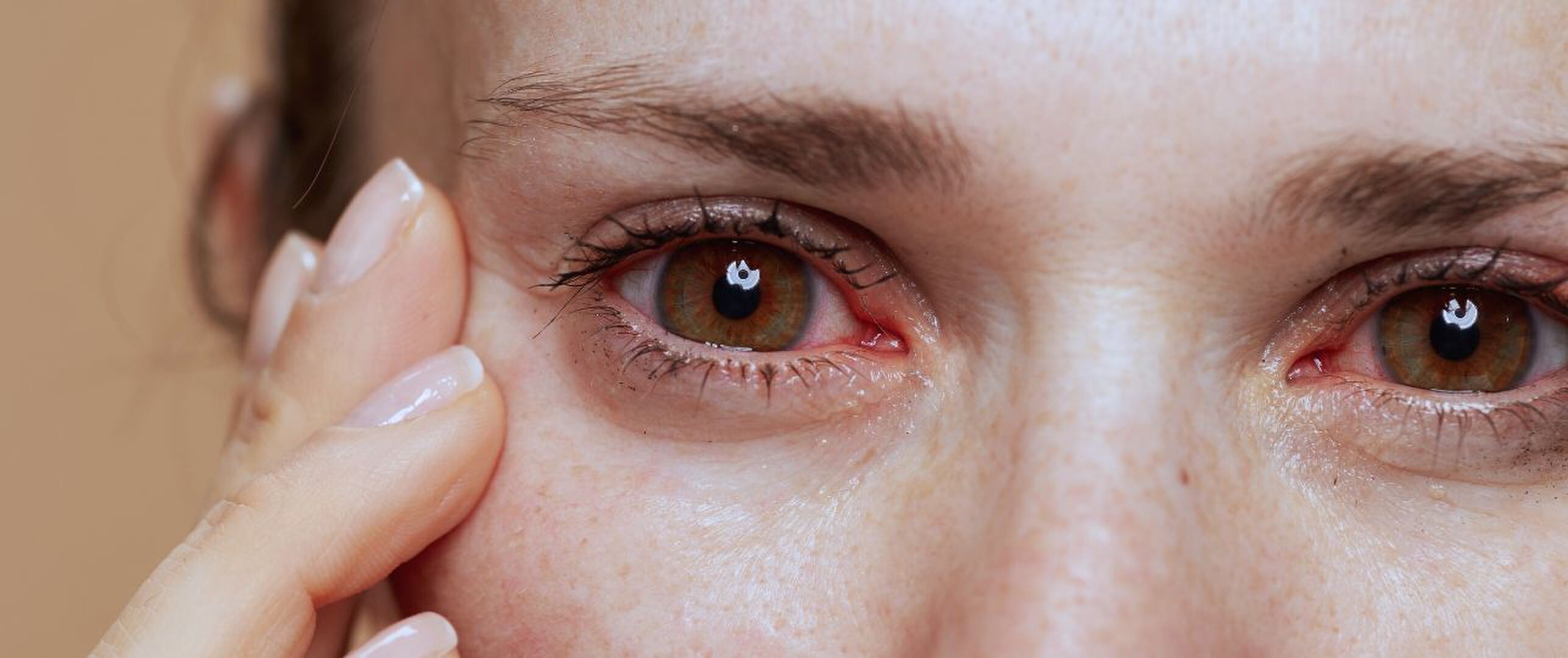 Gele puntjes, rood en vlekjes in je oogwit is dit ernstig?