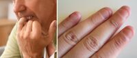 Nagelbijten