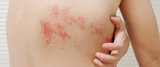 gordelroosvaccin