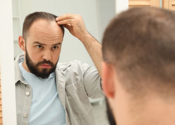 kaal worden, beginnende kaalheid