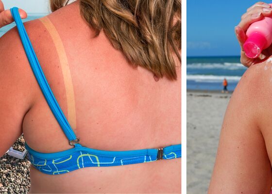 Dag van de zonnebrand