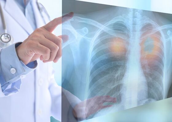 Is een neuro-endocriene tumor kwaadaardig?