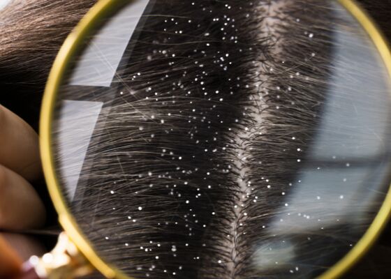 Last van roos in haar