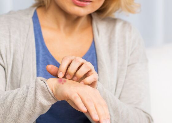 Scabiës-golf in huisartsenpraktijken: schurft terug op niveau