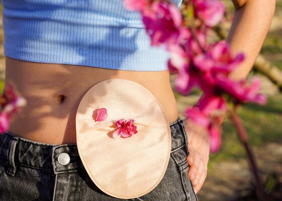 Darmkanker bij jongeren gestegen