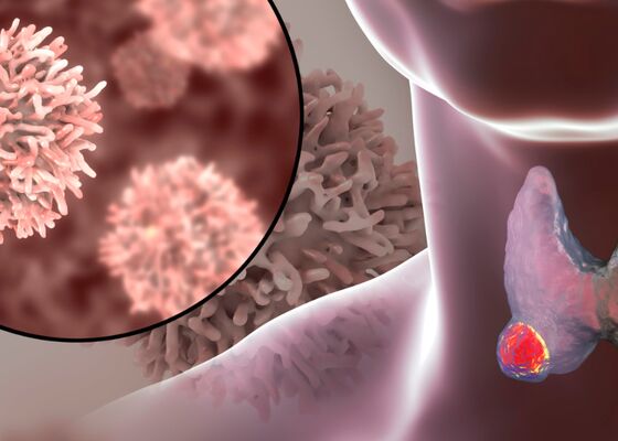 Schildklierkanker behandelen met cryo- ablatie