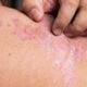 Psoriasis-aandoening-nederland